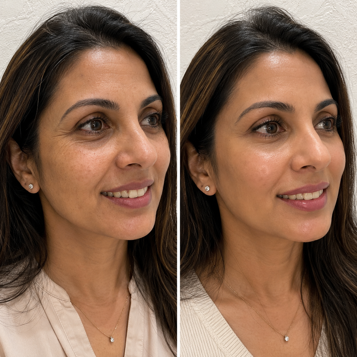 Botulinum Toxin (Botox) – Full Upper Face