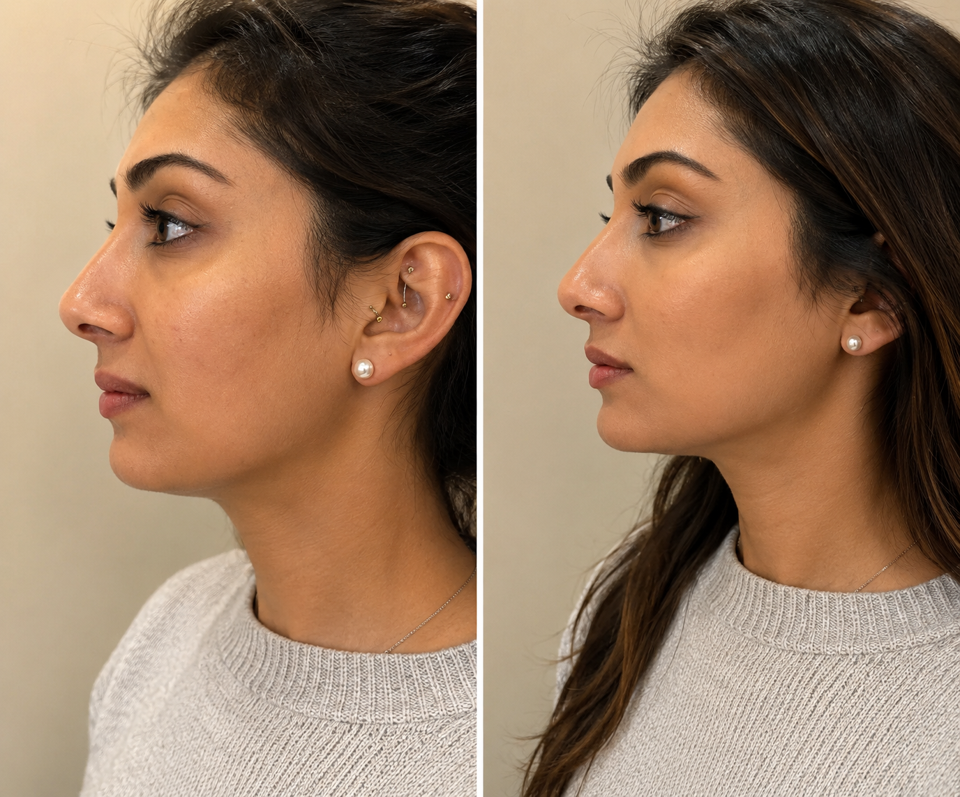 Botulinum Toxin (Botox) – Full Upper Face
