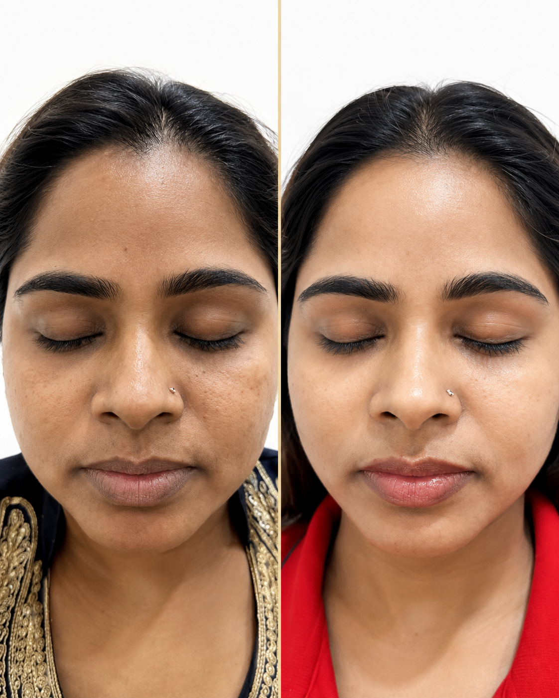 Laser Toning & Brightening