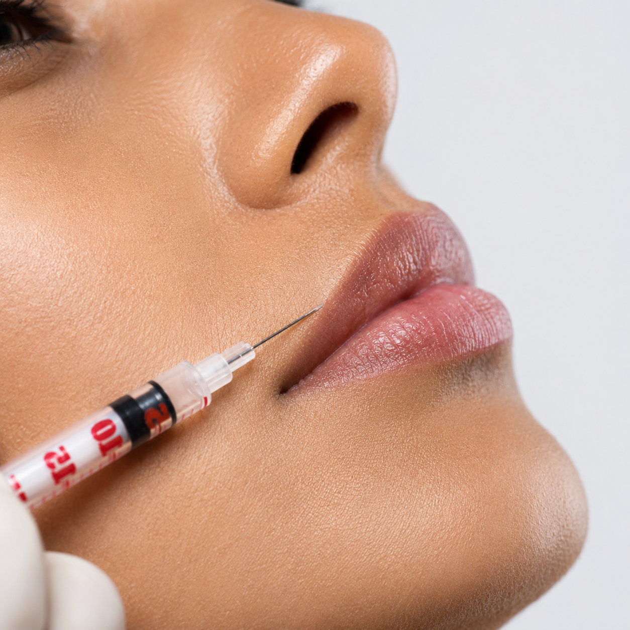 Lip Enhancement with Dermal Fillers (Juvederm Ultra XC)