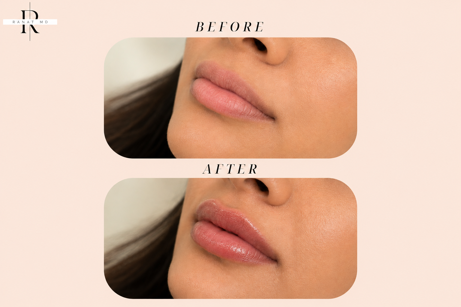 Lip Enhancement with Dermal Fillers (Juvederm Ultra XC)