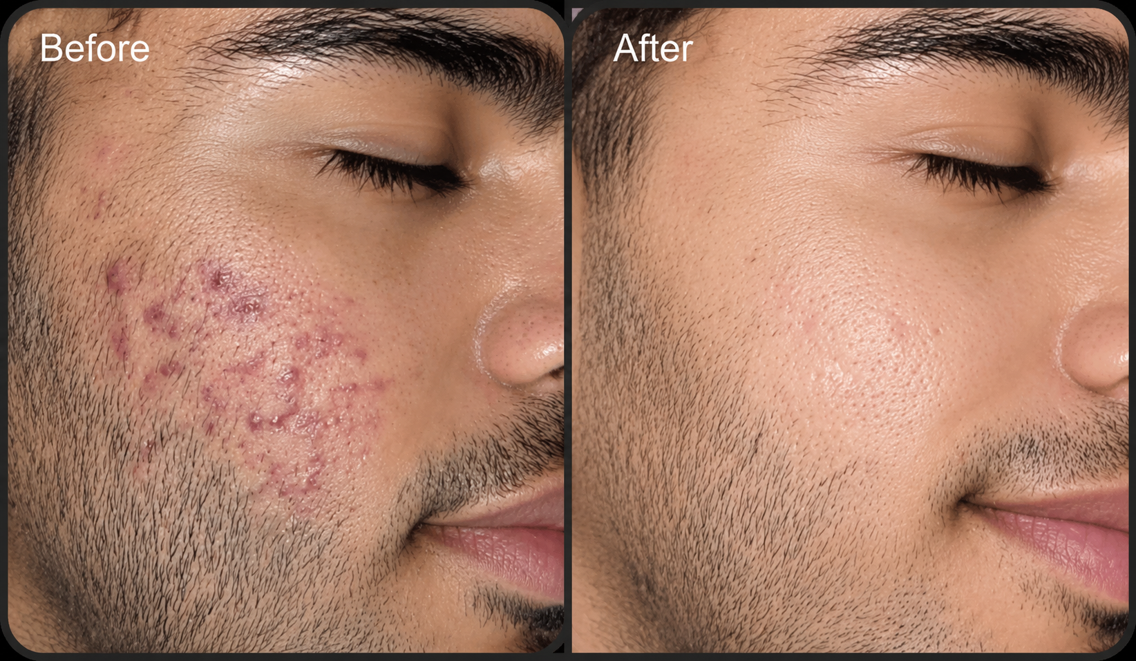 Chemical Peel – Glow Peel