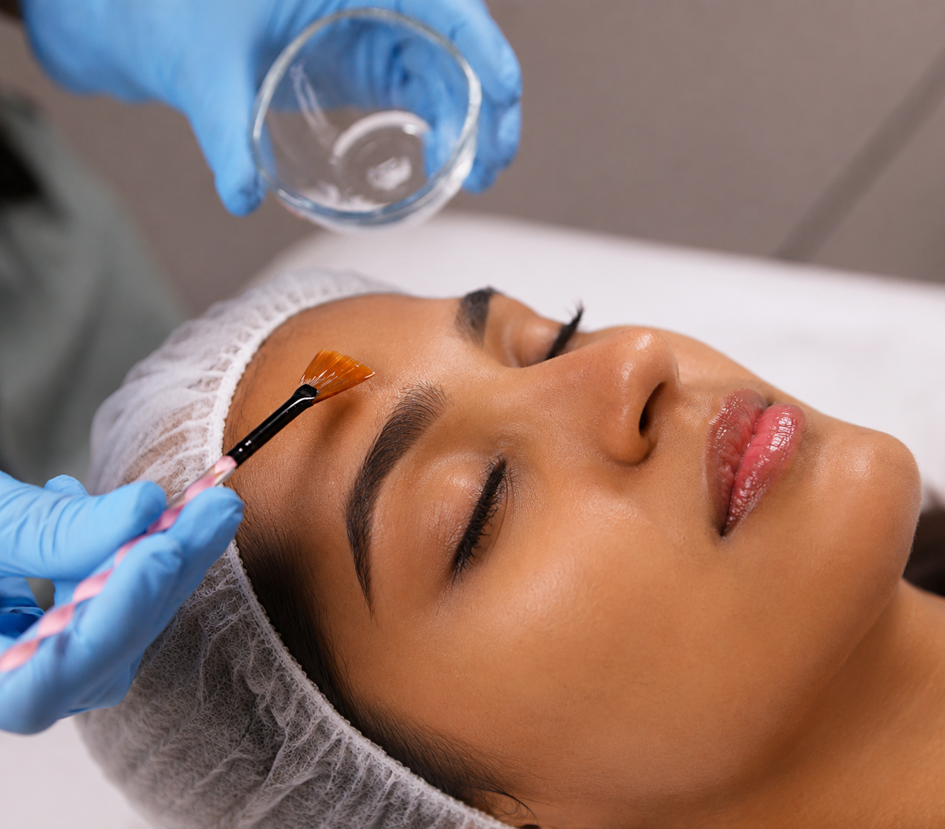 Chemical Peel – Glow Peel