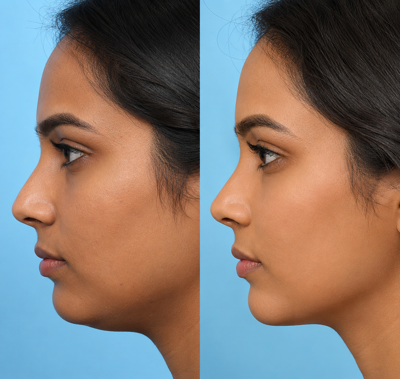 Chin Augmentation with Dermal Fillers