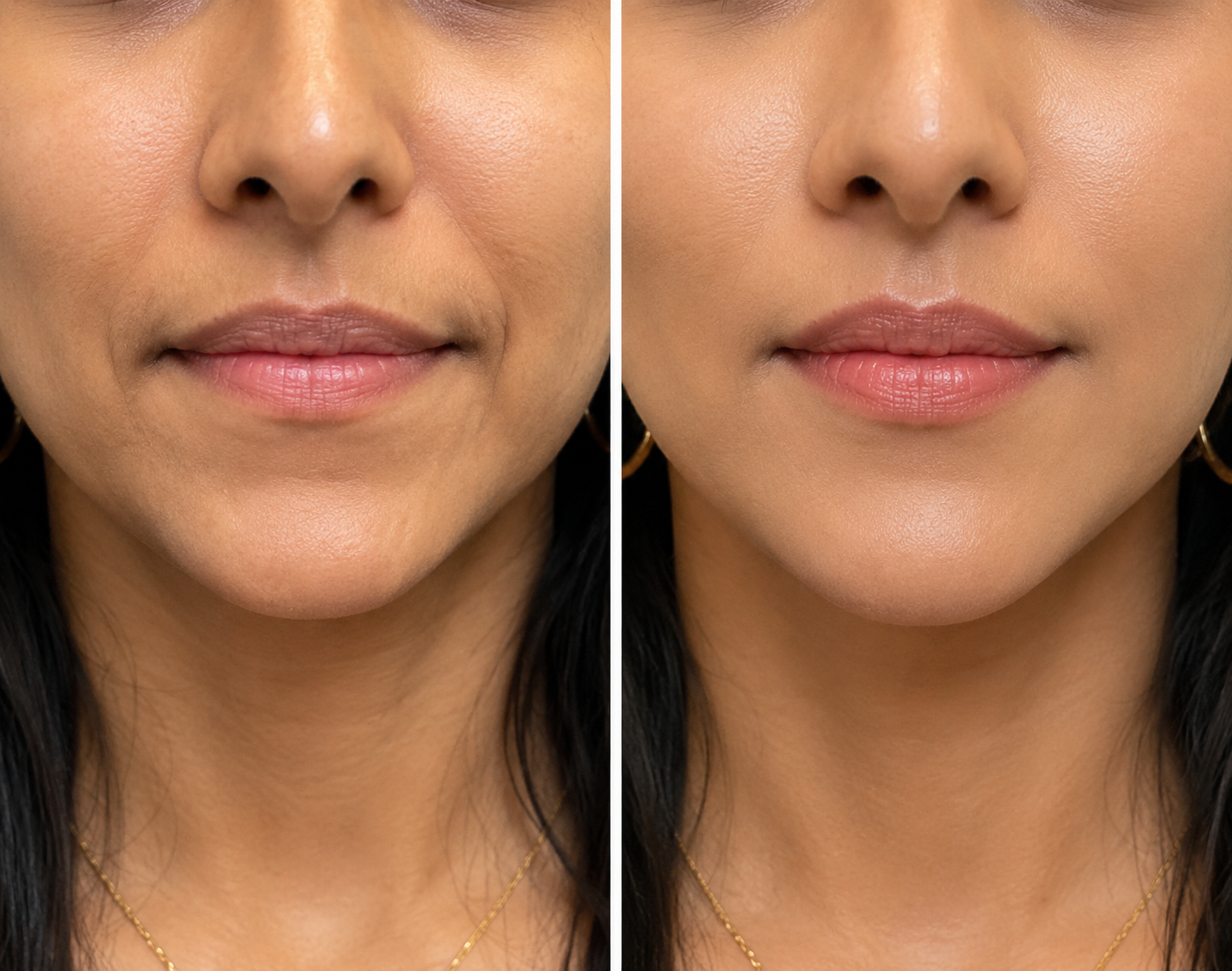 Chin Dimpling (Botox)