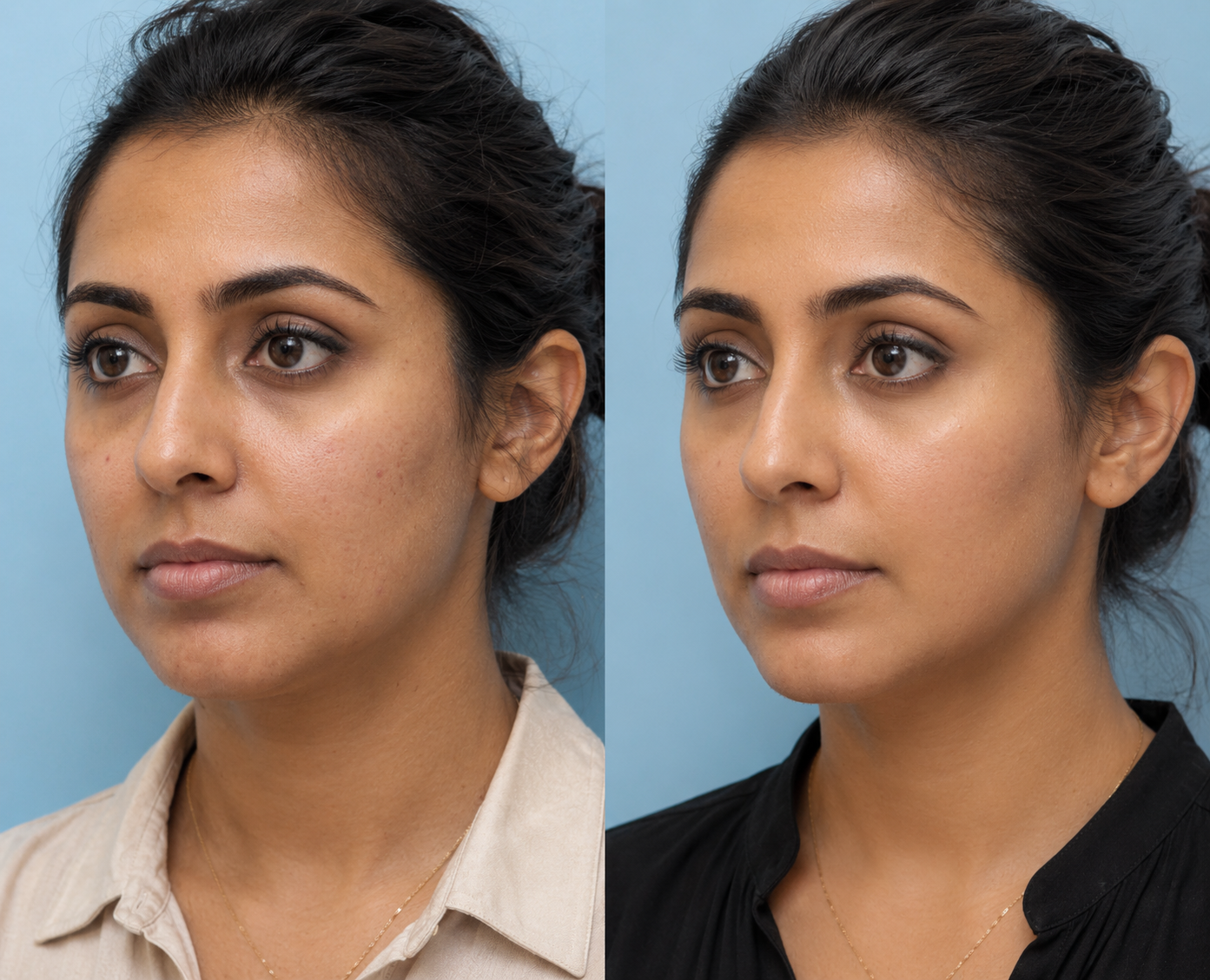Chin Dimpling (Botox)