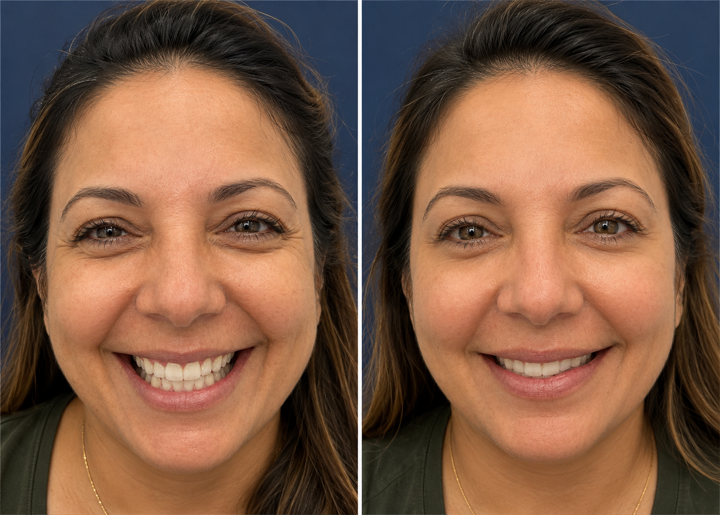 Botulinum Toxin (Botox) – Full Upper Face