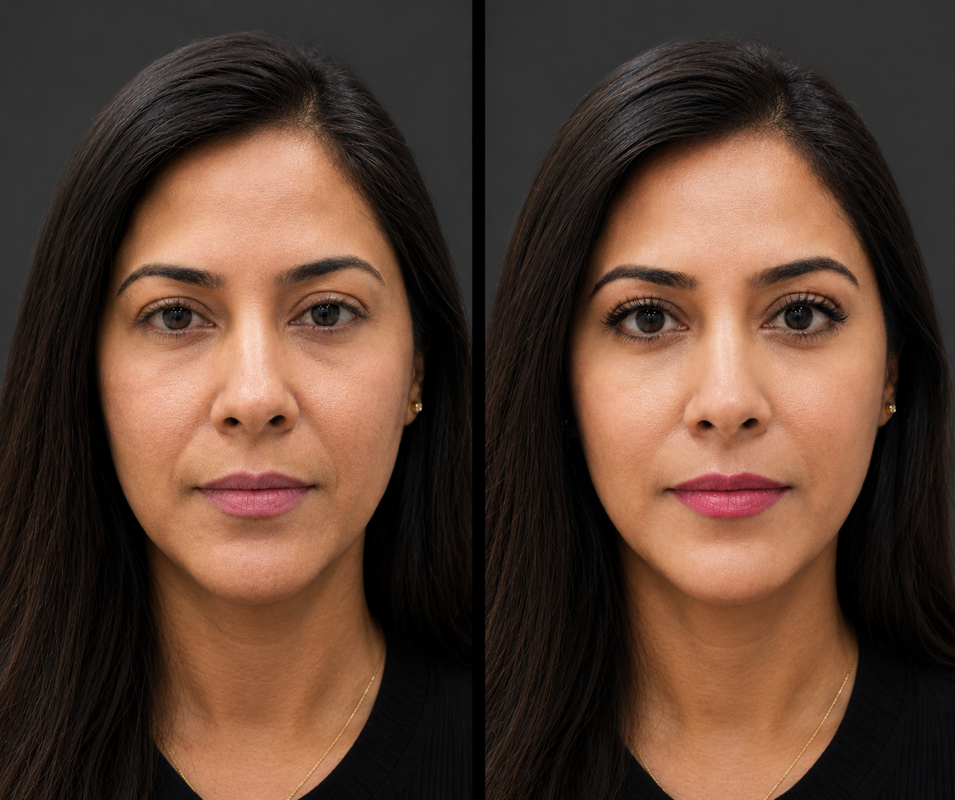 Botulinum Toxin (Botox) – Forehead Rejuvenation