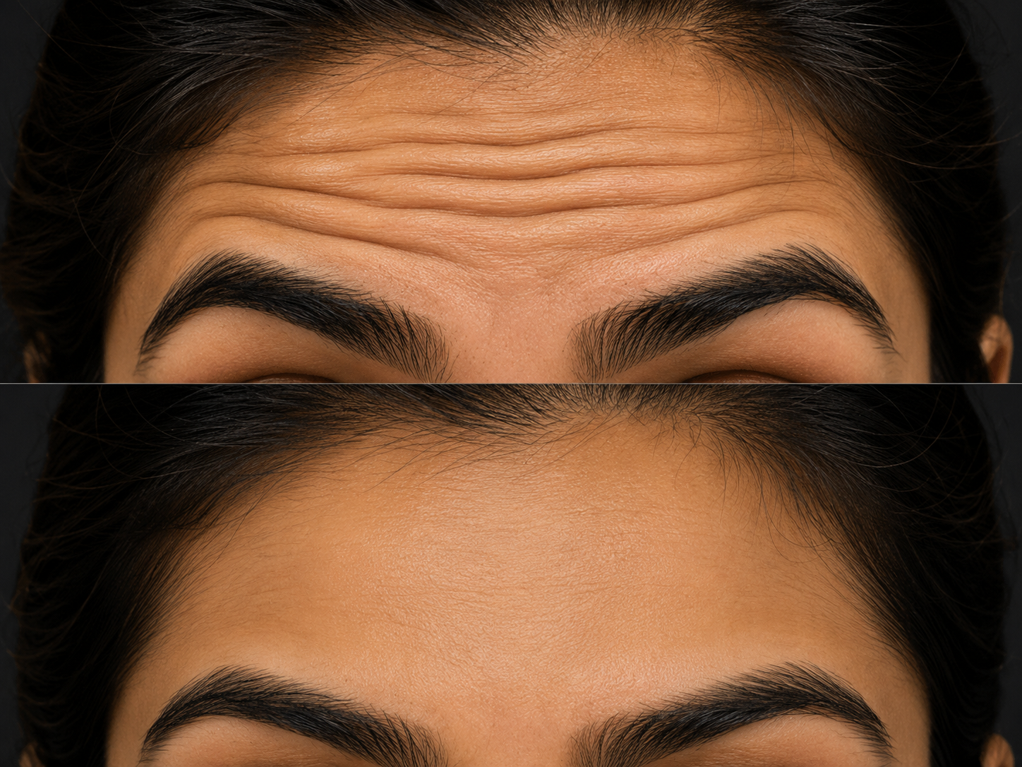 Botulinum Toxin (Botox) – Forehead Rejuvenation