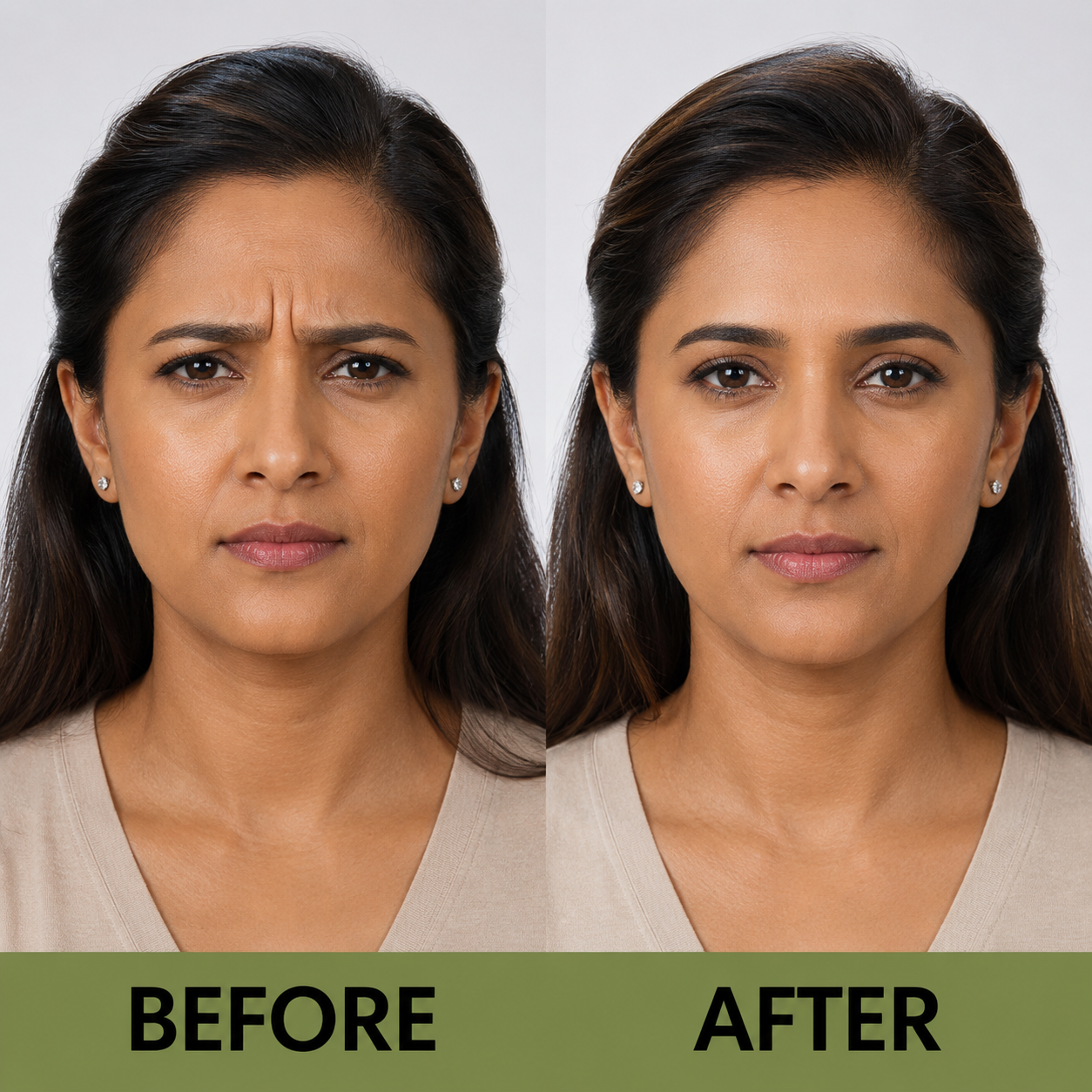 Botulinum Toxin (Botox) – Forehead Rejuvenation