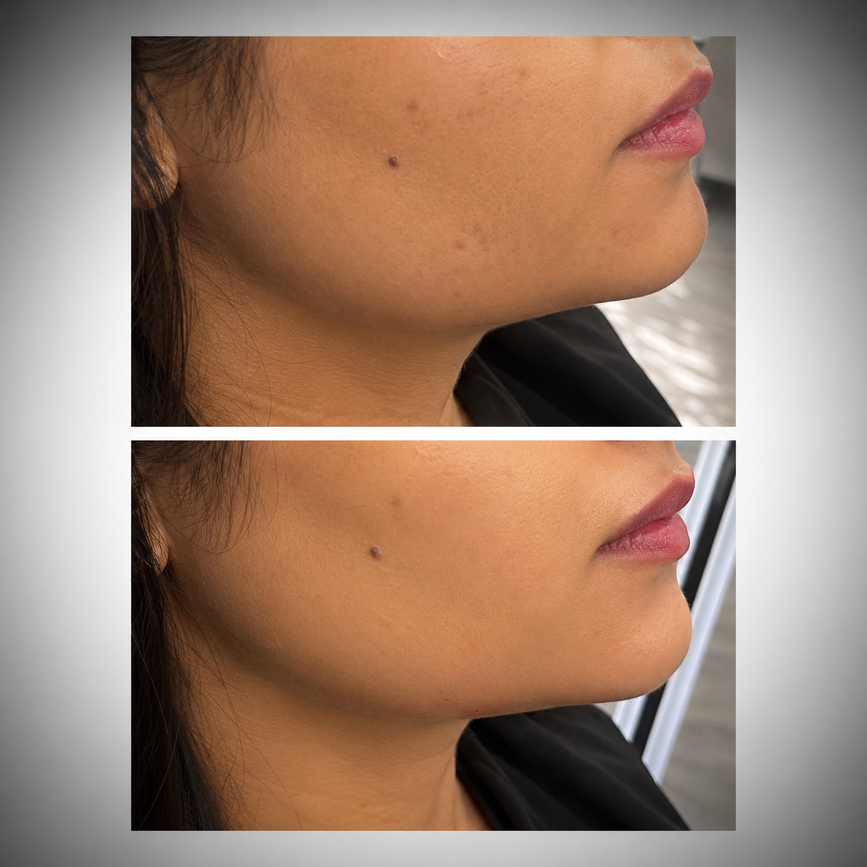 Jawline Contouring with Dermal Fillers and Botox