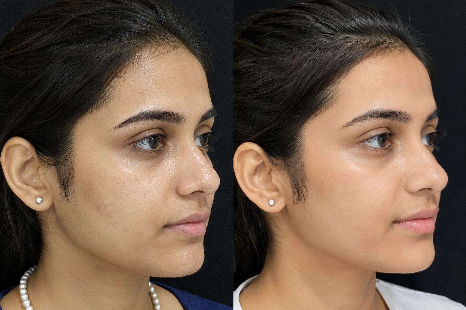 Laser Toning & Brightening