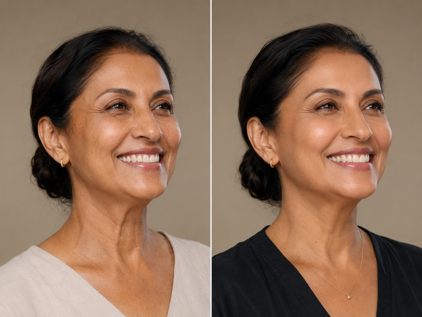 Neck Lift (Nefertiti lift) - Botox