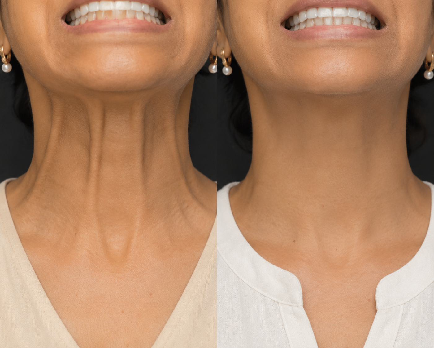 Neck Lift (Nefertiti lift) - Botox