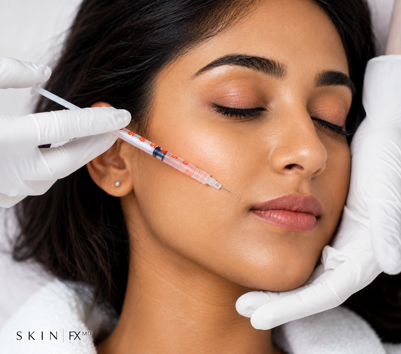 Smile Lines (Nasolabial folds)