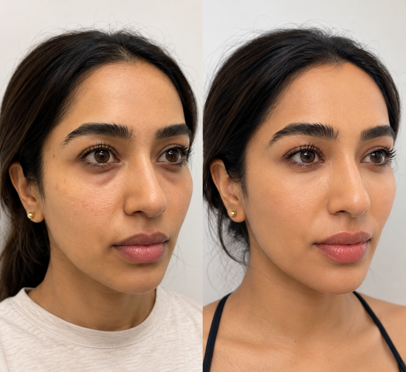 Under-Eye Rejuvenation with Dermal Fillers (Juvederm Voluma)